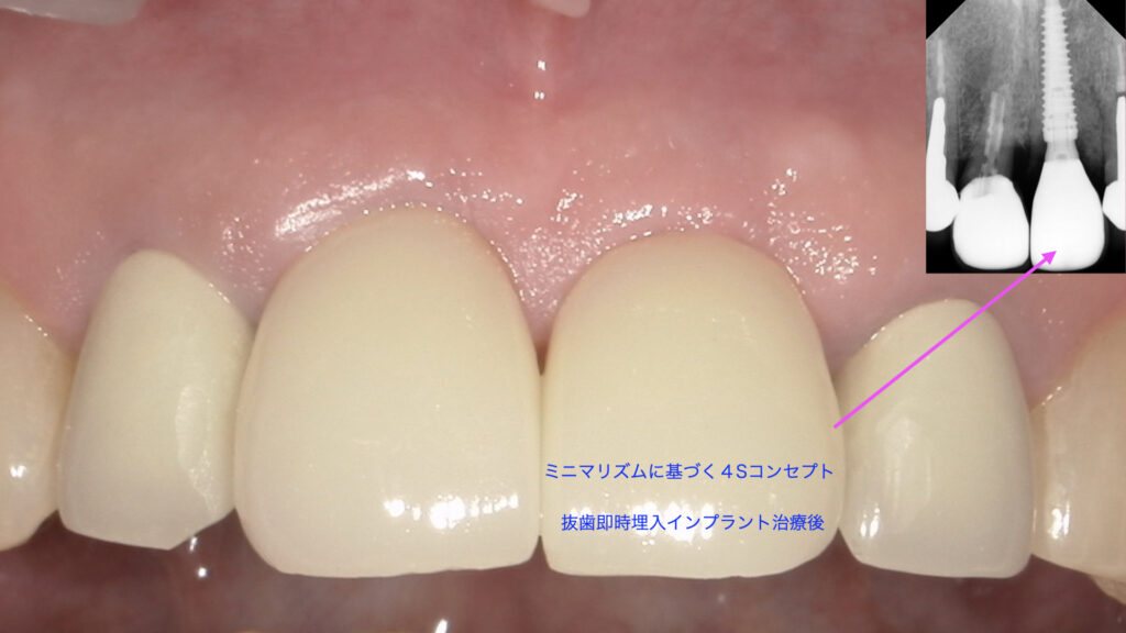札幌市の歯医者「谷口歯科診療所」の抜歯時に骨がしっかり残っている場合のメリット
